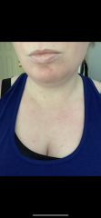 Allergy specialist in Birmingham? And Anyone used Xolair injections?