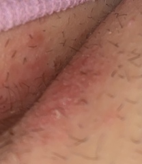 Yeast infection or herpes?