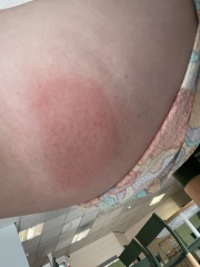 Infected insect bite!!