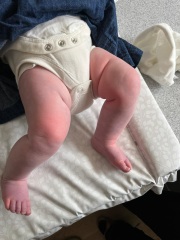 Fingers / toes randomly go red and swell