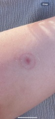 Tick bite?