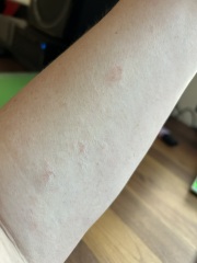 Is this eczema