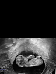 Gender guess scan at 12 weeks