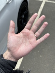 blotchy rash on palm of hands/soles of feet