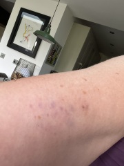 Small purple bruises on arm keep coming back