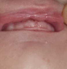 Teething at 11 weeks???