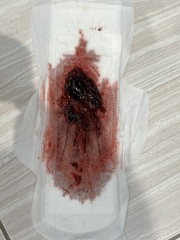 TMI pics - D&C 3 weeks postpartum - retained products and blood clots