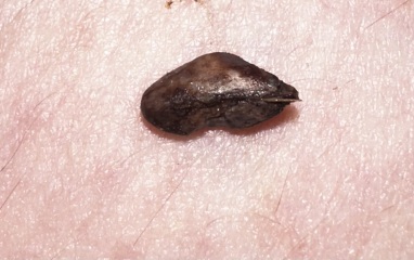 TMI what is this looks like stone in vulva area? **pics in comments**