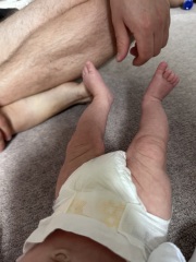 Clubbed foot? - questioning my own GP.