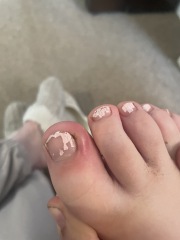 Any nurses about…(beware gross foot pic)