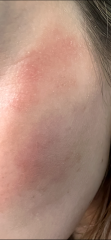 Eczema/Allergies/Diet/HRT/getting older ?