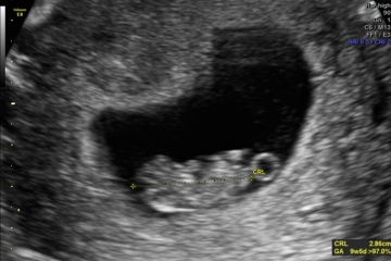Early pregnancy