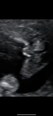 Can anyone tell gender from ultrasound scan ?