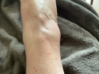 Calling all Pest Detectives! (With photo of ankles/bites)