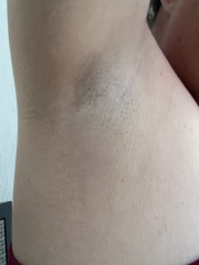 Worried about lump under armpit. I was recently diagnosed with the chek2 gene mutation