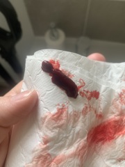 Miscarriage or period clot