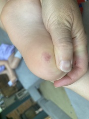 Has this verruca gone?!