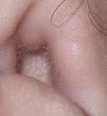 Swollen Ear Canal (Tw pics)