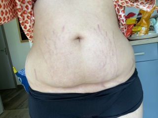 loose skin (help)