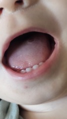 Is this blister in babys tongue? (Pic)