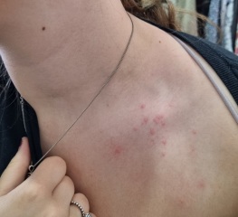 Does this look like the start of shingles?