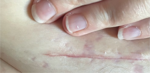 C section infection not clearing after 4 rounds of antibiotics!