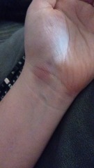 Bruised hand