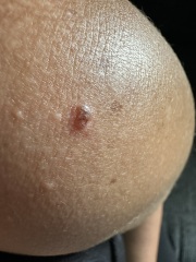 Does this mole look suspicious