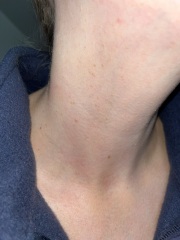 Cluster of warts / skin tags on neck