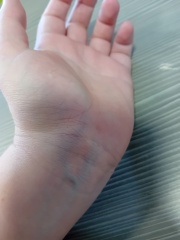 Bruised hand