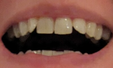 Invisalign - how much did yours cost and was it worth it?