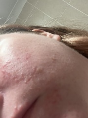 Acne or rosacea or?