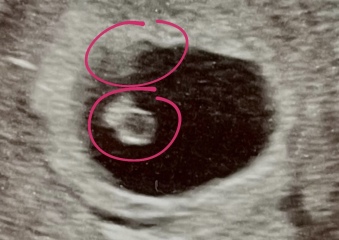 Twins on scan?