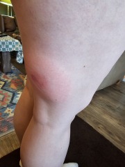Horse fly bites? Photo