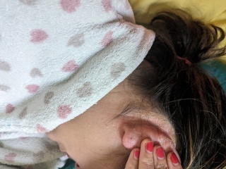 Does this look like eczema to you?