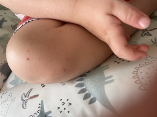 HFMD or chickenpox?
