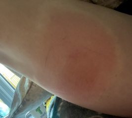 Infected insect bite!!