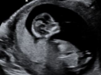 12 week scan - nub/ skull theory 