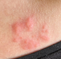 What’s this rash?