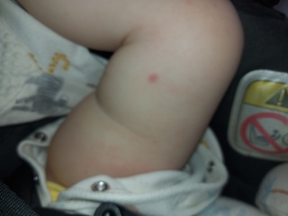 Could this be chicken pox