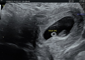11 weeks showing?