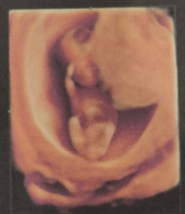 Gender based on 13 week scan