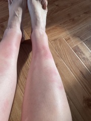 Erythema Nodosum