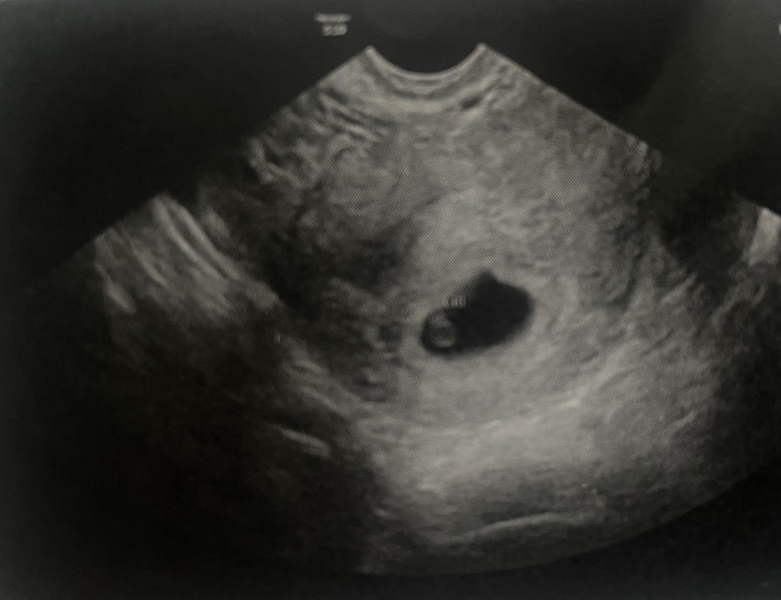 Ramzi theory scan photo