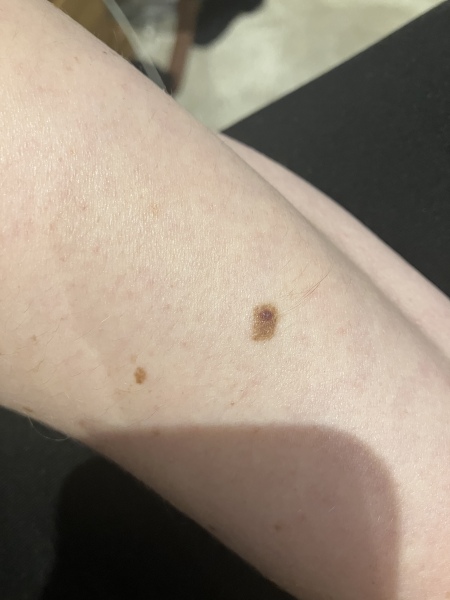Really anxious about my mole