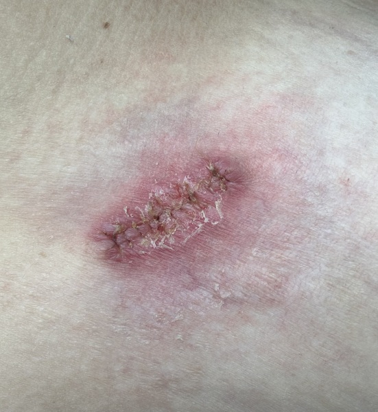 Skin biopsy would infection