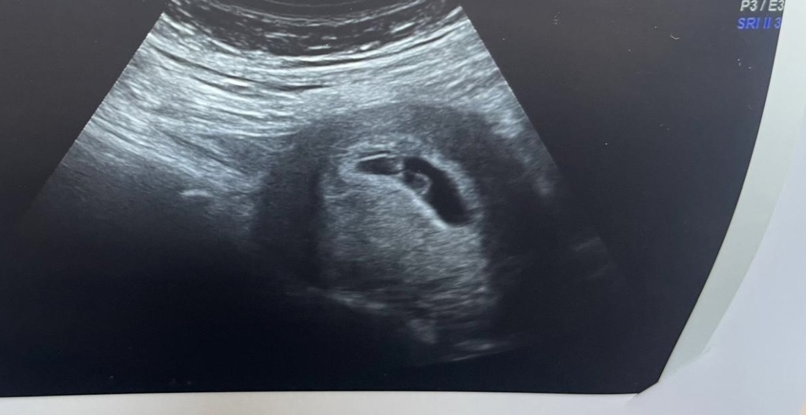 Scan at 6 weeks 5 days
