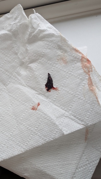 TMI_Bleeding with a small clot_6 weeks 3 days