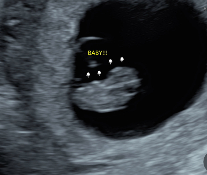 BFP after recent loss (Thread 2) 🌈