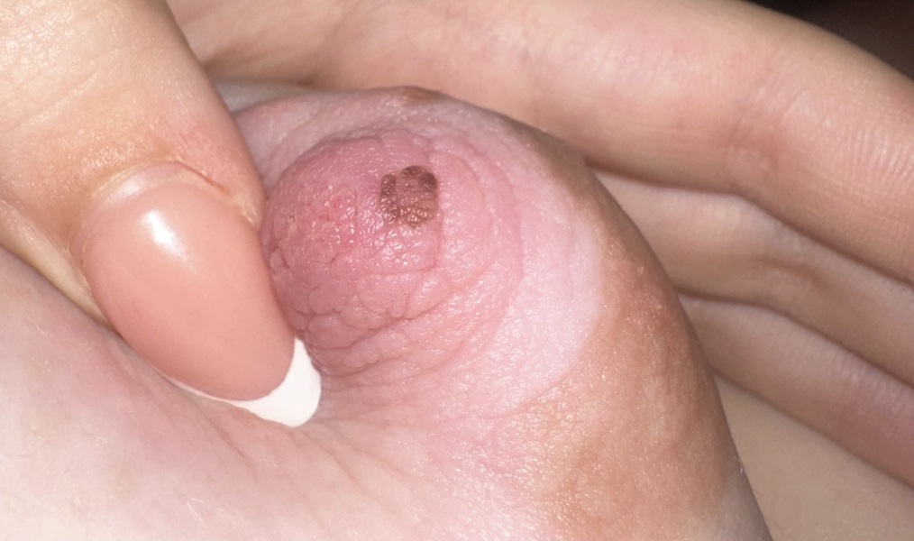 Pregnant and Brown Mole on Nipple